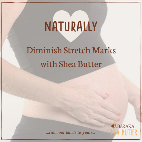 Naturally Diminish Stretch Marks with Shea Butter